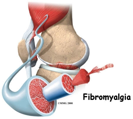 Chest Pain in Fibromyalgia: Causes, Symptoms, Treatment